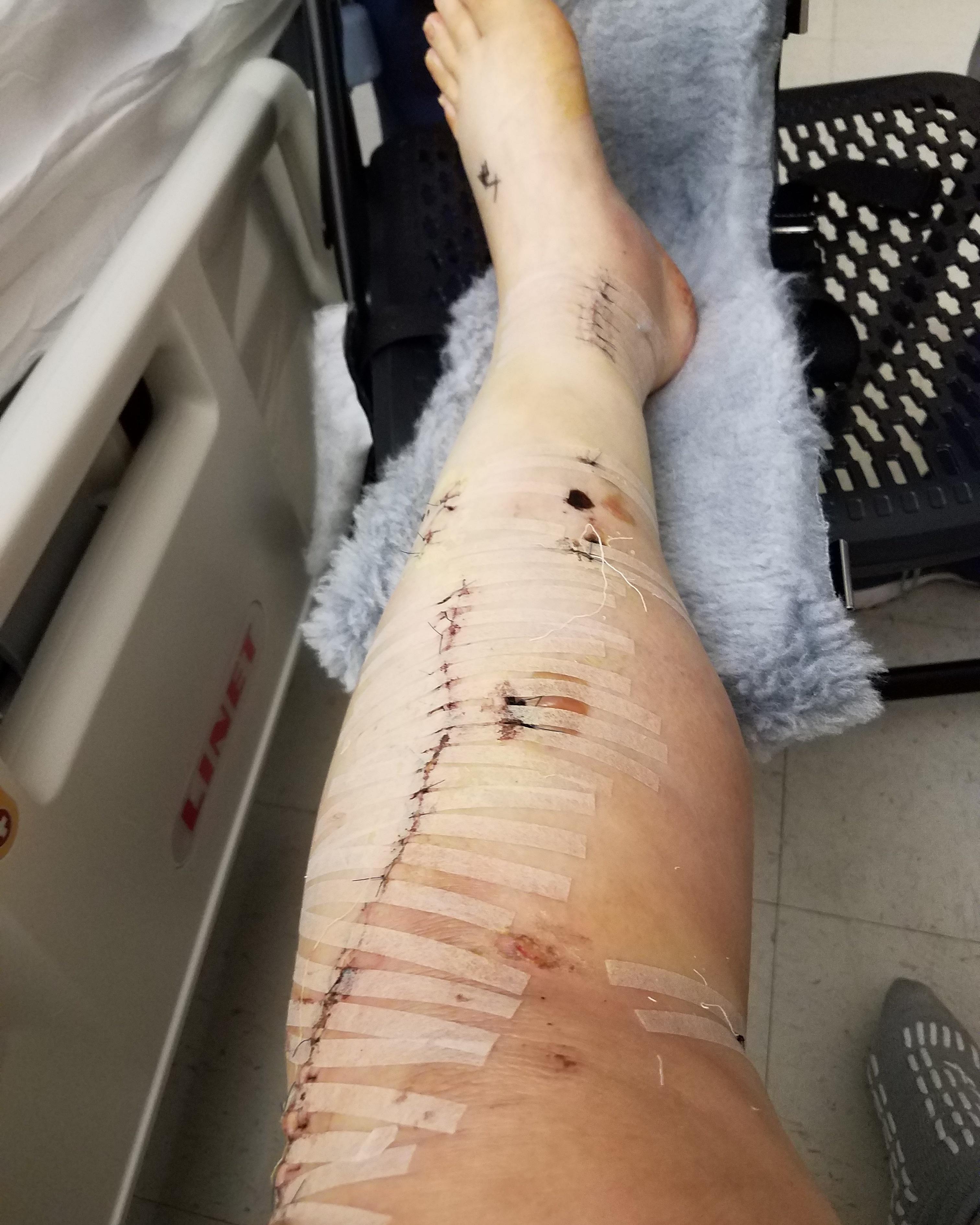 rajalary, julie lary, richard lary, scribbles writing, injured leg